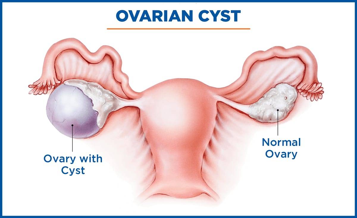 laparoscopic ovarian cystectomy in Ghansoli 1